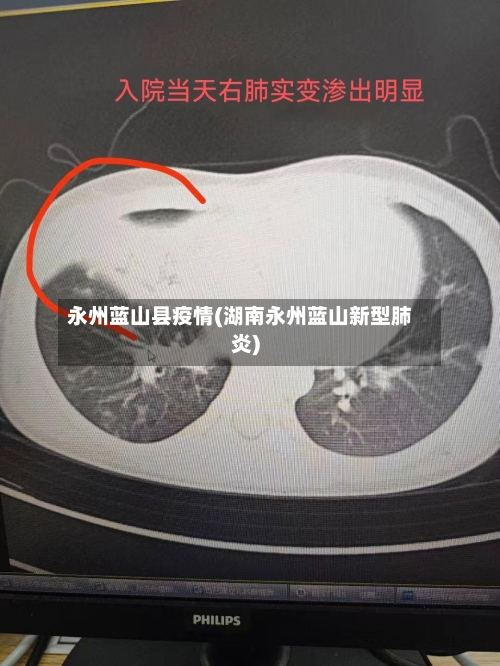 永州蓝山县疫情(湖南永州蓝山新型肺炎)-第2张图片